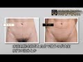 【ゴリラ脱毛】森下拓也さん05｜「VIO」の完全脱毛に挑戦