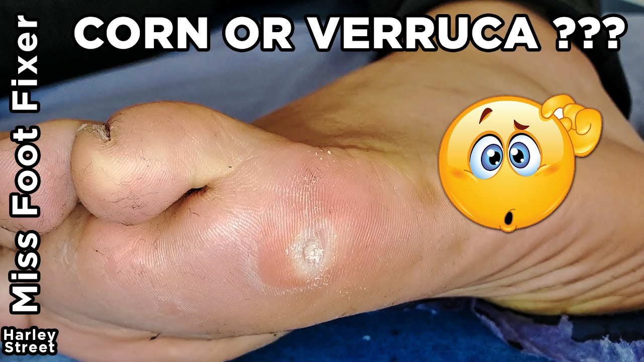 Corn or Verruca confusion, what do you think? Miss and Mr Foot Fixer