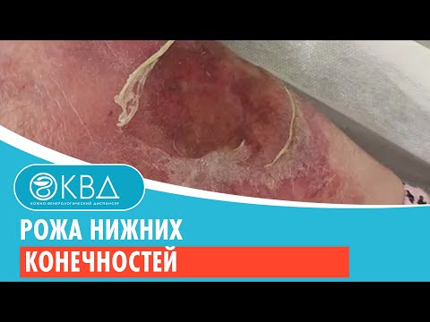 😲 Рожа нижних конечностей. Клинический случай №913