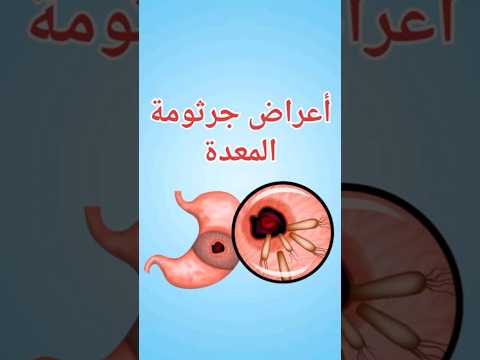 اعراض جرثومة المعدة جرثومة المعدة