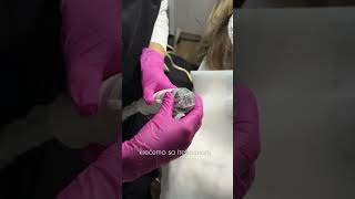 RF Microneedling