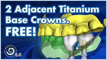 BSPV5.0: 2 Adjacent Crowns for Titanium  Base. Designed & Exported Free!