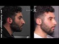 Male Rhinoplasty before &amp; after result 180° view | Ρινοπλαστική Πριν &amp; Μετά σε βίντεο 180°