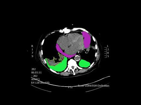 Chest Computed Tomography (CT) with pleural and pericardial effusions