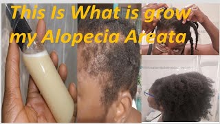 DIY Hair Growth Fertiliser, For Hair Loss Fall And Alopecia Areata Growth, Daily Hair Growth Spray