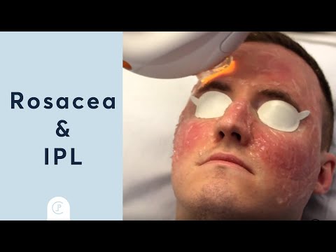 Rosacea Treatment at Pulse Light Clinic London