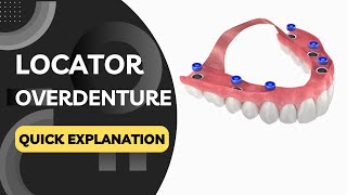 What are Locator Overdentures Quickly Explained in a Few Seconds!