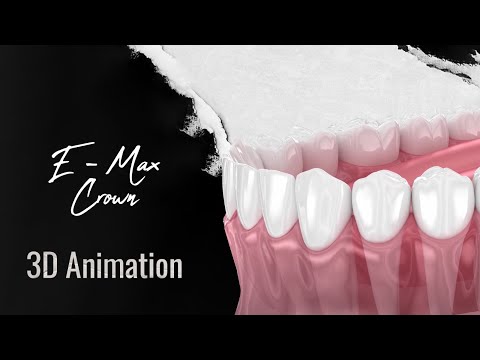 E-Max Crowns: The Ultimate Solution for Natural-Looking Dental Restorations - 3D Animation