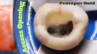 Access Opening 🟡 mandibular second molar ⚪️ Biomechanical Preparation with Protaper Gold 🔴