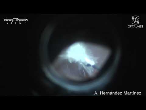 Desprendimiento de retina traccional por retinopatía diabética