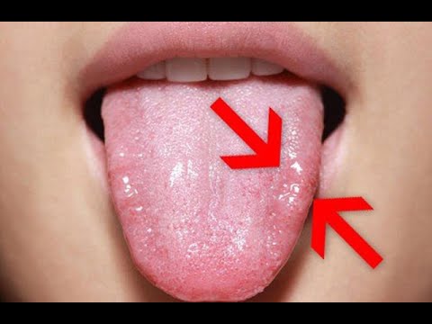 Candidosi della bocca, sintomi e cure