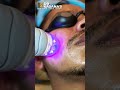 Microneedling for Acne Scars | Before and After | Vivace MNRF Treatment