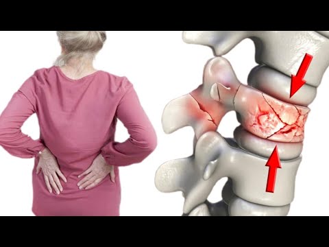 Video: Moet ek prolia neem vir osteoporose?