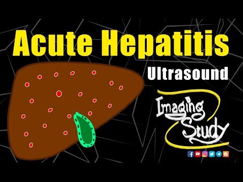Acute Hepatitis || Ultrasound Lecture || Imaging Study