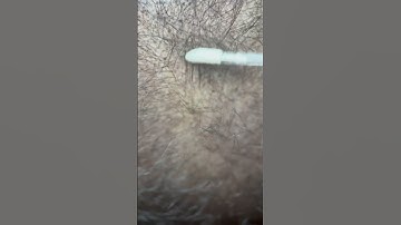 Scalp Micropigmentation before/after- Belris - Los Angeles #smp #hairloss #hairtattoo #pmu #la