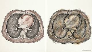Beyond the Primary Indication: Full Value of Chest CT Through Opportunistic Imaging Biomarkers