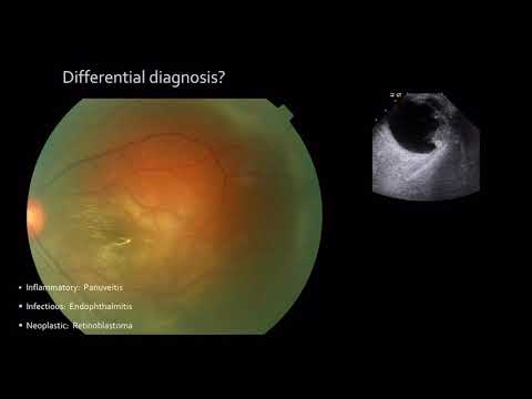 An approach to Leucocoria: Ophthalmology MSc taster lecture