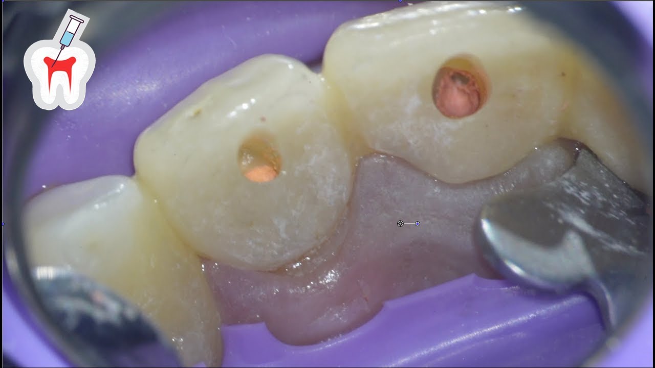 Anterior Root Canal Procedure 2 Upper Centrals Retreatment YouTube