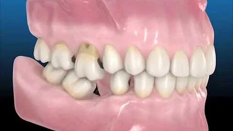 ¿Cómo afecta la pérdida de dientes a la cara?