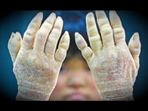 奇病 この女性の手の奇病が恐ろし過ぎる 世界に数例 残毀性遺伝性角皮病 閲覧注意 Youtube