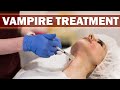 Vampire treatment | PRP injections for face