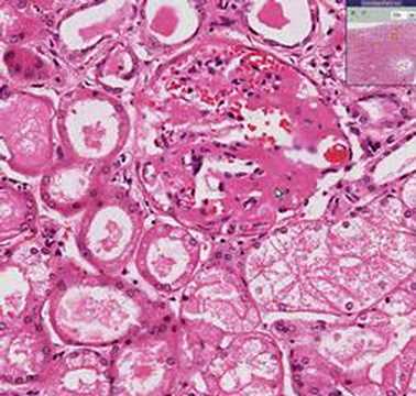 Video: Nephritis Interstisial Karyomegalic Dengan Novel Gen FAN1 Mutasi Dan ALECT2 Amyloidosis