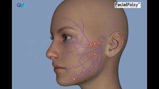 Understanding Facial Palsy