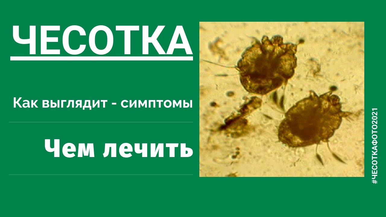 Как уберечься от чесоточных клещей?