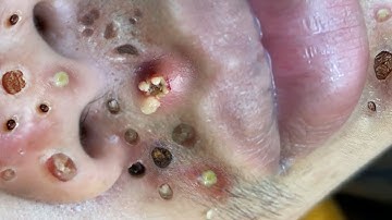 Loan Nguyen Acne Treatment 1635h