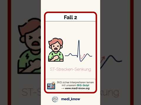 Video: Erscheinen Herzinfarkte im EKG?