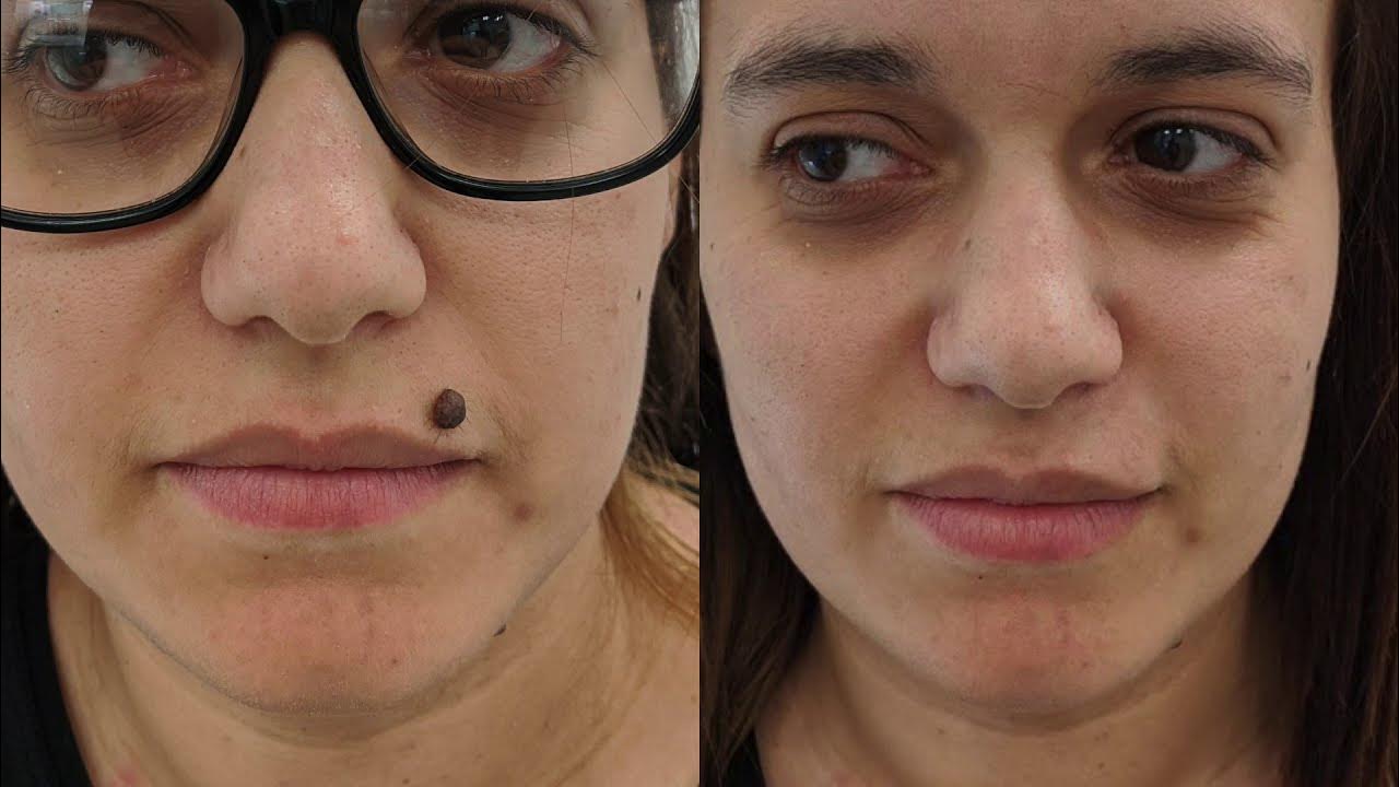 facial-mole-removal-demo-large-mole-removed-from-upper-lip-fast-and