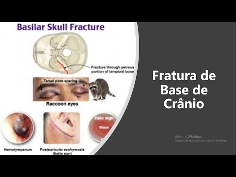 Vídeo: Fratura Da Base Dos Ossos Do Crânio - Sintomas, Sobrevivência, Consequências E Tratamento De Uma Fratura Do Crânio