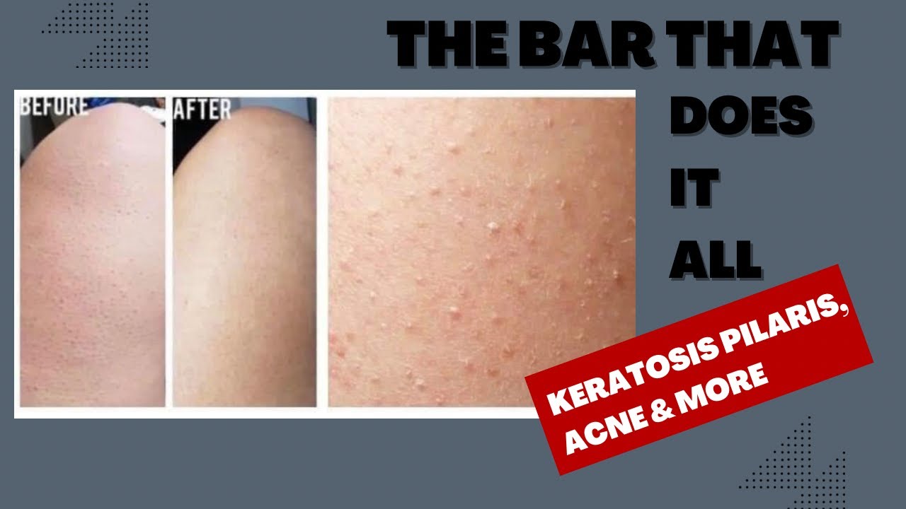 Keratosis Pilaris, Acne, Body Acne Help them all with this MAGIC BAR