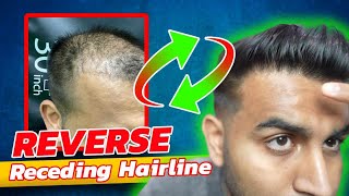 How To Stop/Reverse a Receding Hairline