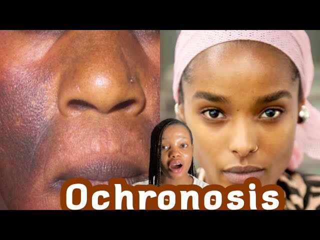 ochronosis treatment