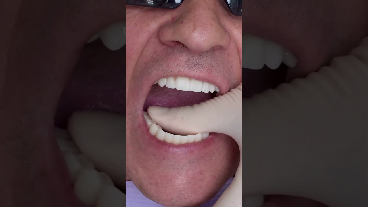Dental Implant S All On 4 In Prague Shorts Dentist Veneers Short