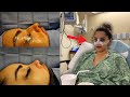 I GOT A NOSE JOB... THIS WAS MY EXPERIENCE!!