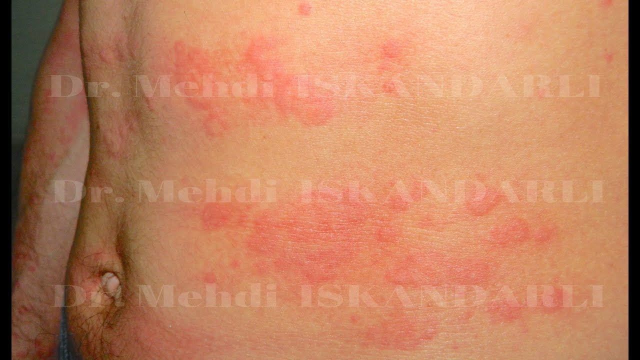 Övrə xəstəliyi | Dermatoloq Mehdi İskəndərli
