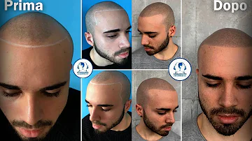 Come capire se soffro di calvizia?