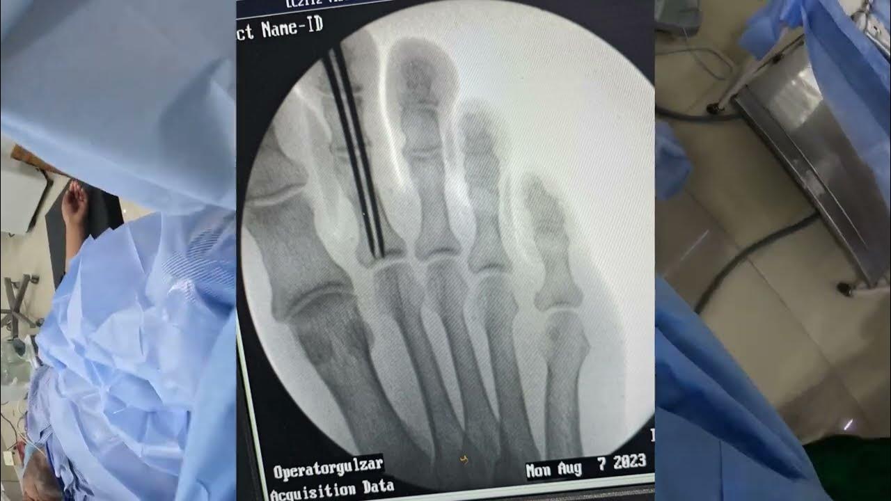 K WIRING FOR TOE FRACTURE - YouTube