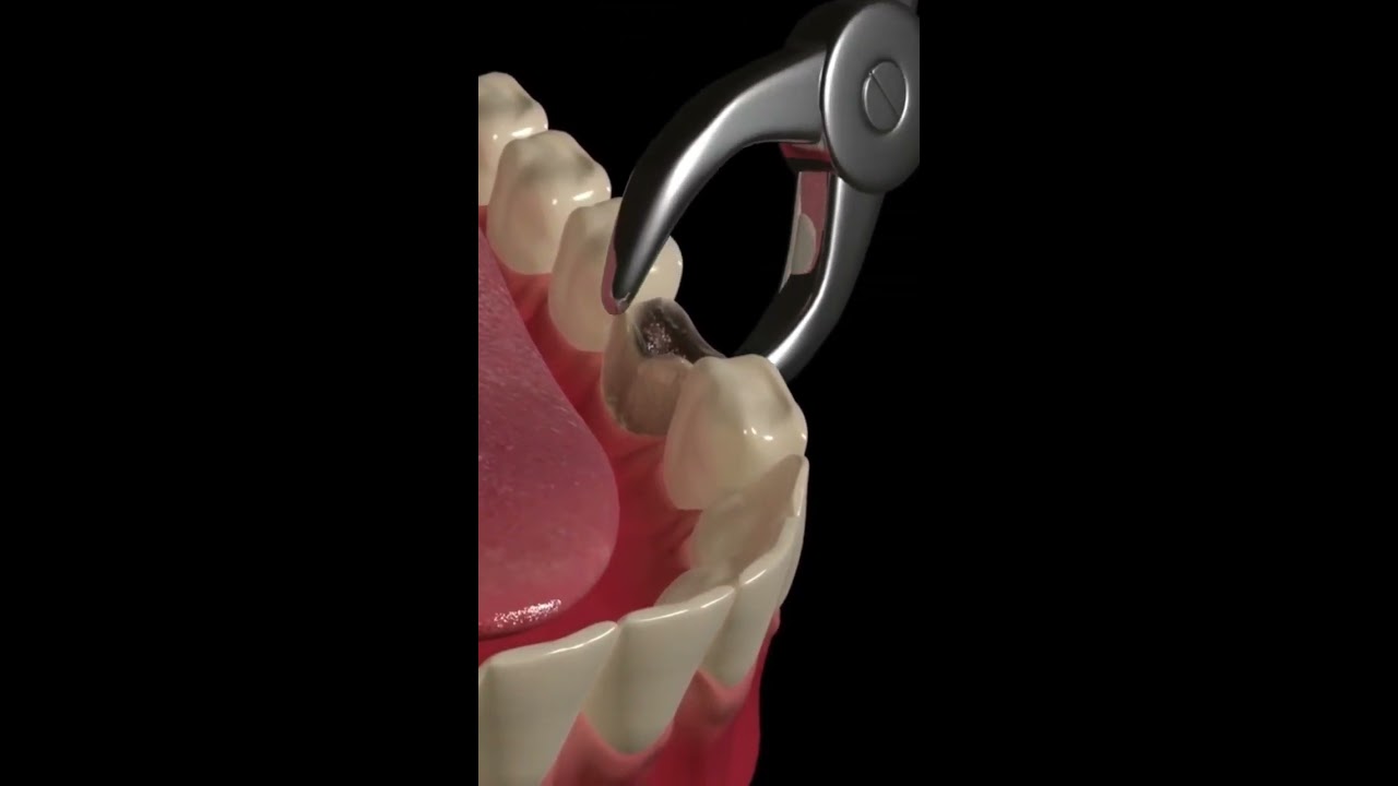 Animated Dental Extraction Procedure