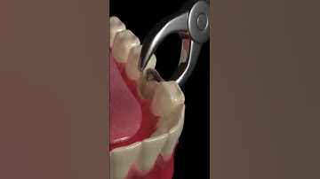 Thumbnail of Animated Dental Extraction Procedure