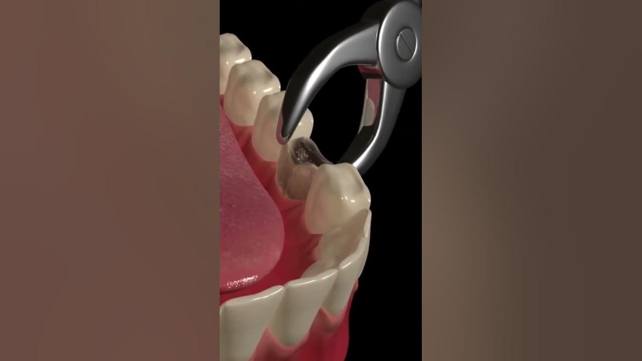 Animated Dental Extraction Procedure
