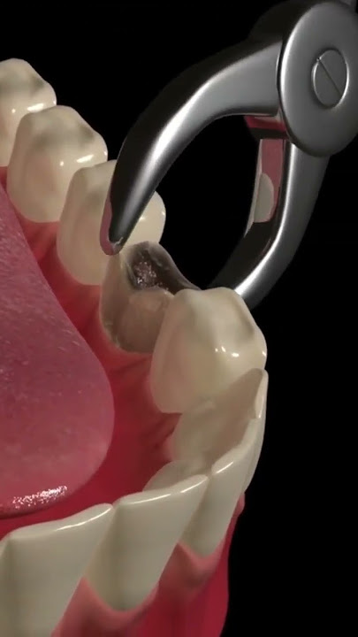 Animated Dental Extraction Procedure