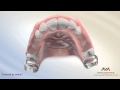 Orthodontic Space Management - Nance Appliance