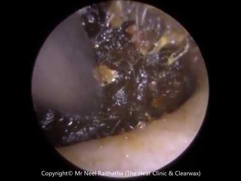 Blocked Ear Removal Extraction by Ear Wax Removal Specialist Mr Raithatha   Ep 287