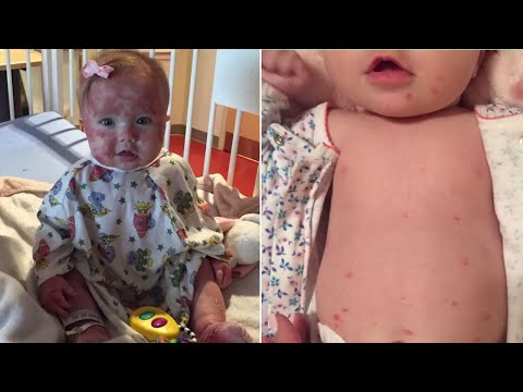 Mom Kisses Daughter with Skin Disease to Show Strangers She's Not Contagious