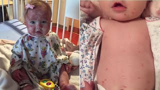 Mom Kisses Daughter with Skin Disease to Show Strangers She's Not Contagious