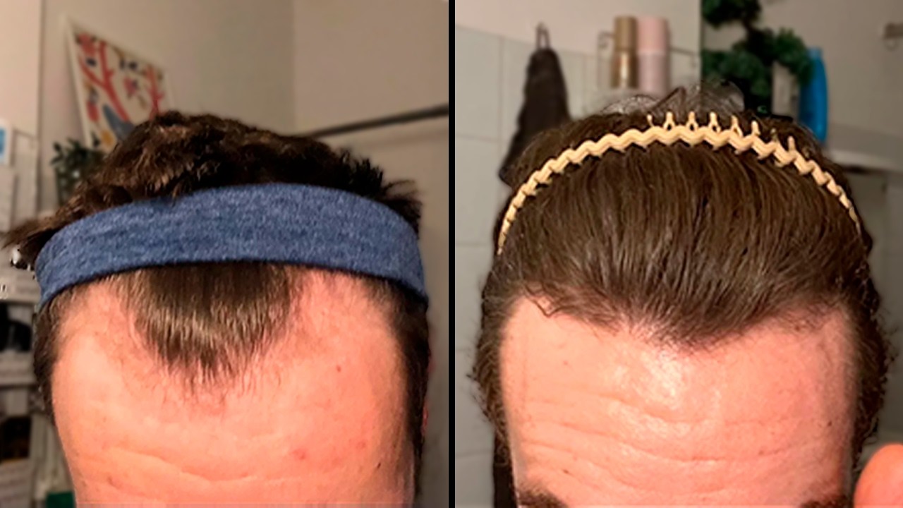 ¡Sin Injerto! ¿Cómo Este Hombre Recuperó Su Pelo En 5 Meses?