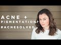 Acne Marks, Scarring & PIH? Everything To Know! #AcneSolved - Part 3 | Dr Sam Bunting